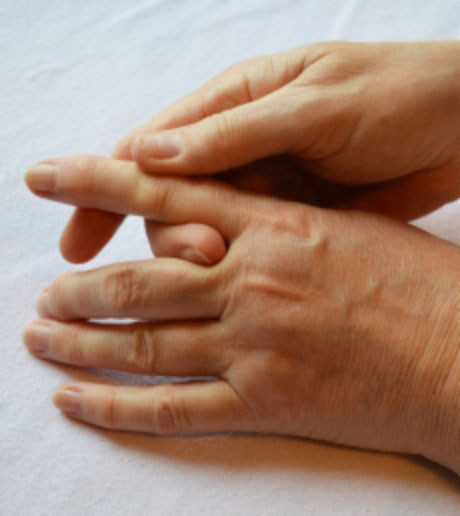 Image of hands with psoriatic arthritis
