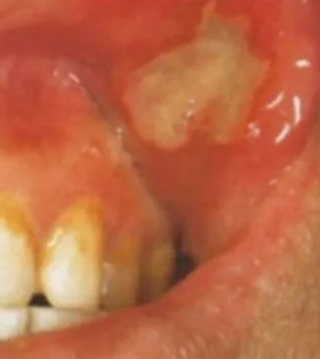 Oral ulcers inside the mouth area