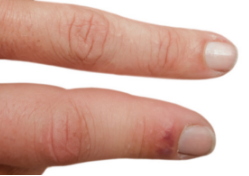 Swollen, tender finger joints