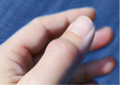 Loss of physical function in hands