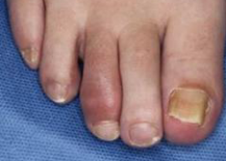 Swollen toes